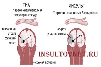 Simptome de atac ischemic tranzitor și diagnostic