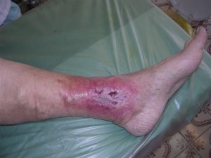 Ulcer trofic pe unguent pentru picioare, remediu, tratament cu remedii folclorice