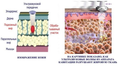 Liposucția ultrasonică a rezultatelor abdomenului și coapsei, recenzii, preț