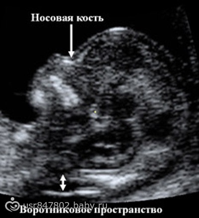 Uzi a terhesség 11-13 hetében, felkészülés az első fontos uzi-ra)