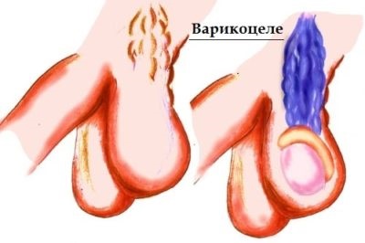 Varikotsele 1 grad ce este, aveți nevoie de intervenție chirurgicală și tratament fără ea, precum și fotografii ale bolii