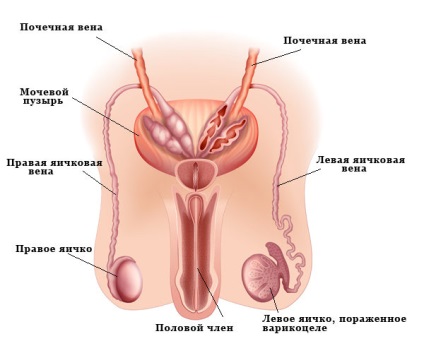 Varikotsele 1 grad ce este, aveți nevoie de intervenție chirurgicală și tratament fără ea, precum și fotografii ale bolii