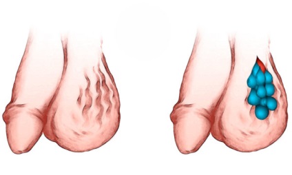 Varikotsele 1 grad ce este, aveți nevoie de intervenție chirurgicală și tratament fără ea, precum și fotografii ale bolii