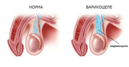 Varikotsele 1 grad ce este, aveți nevoie de intervenție chirurgicală și tratament fără ea, precum și fotografii ale bolii