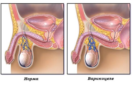 Varicocele a férfiaknál a betegség kialakulásának mértékében