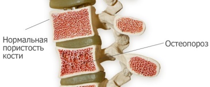 Vertebroplasty coloanei vertebrale și condițiile de tratament