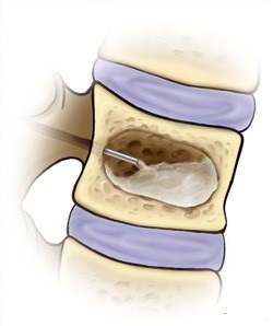 Vertebroplasty coloanei vertebrale și condițiile de tratament