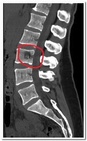 Vertebroplastia coloanei vertebrale (percutanată și puncția), recenzii după intervenție chirurgicală