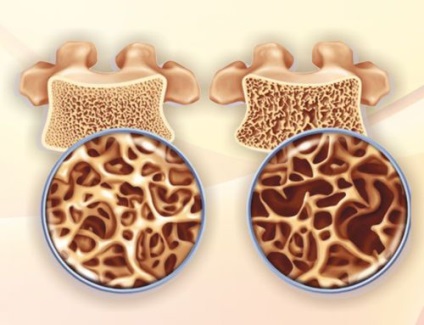 Vertebroplastia coloanei vertebrale (percutanată și puncția), recenzii după intervenție chirurgicală