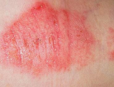 Tipuri de fotografie eczemă, cauze, semne