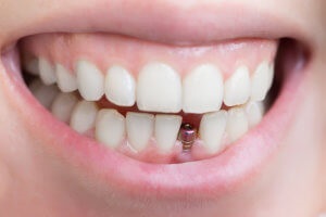 Kérdések fogászati ​​implantátumok leggyakoribb félelmek