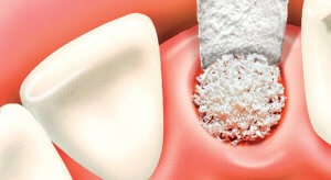 Întrebări legate de implanturile dentare cele mai comune temeri