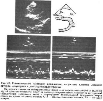 Insuficiență congenitală a supapelor arterei pulmonare