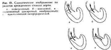 Insuficiență congenitală a supapelor arterei pulmonare