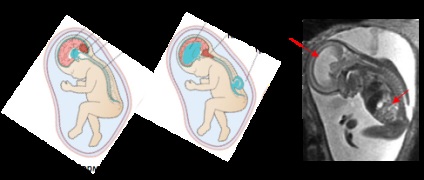 A gerinc és a hernia egy újszülöttben történő szétesése - mik a gyermek egészséges