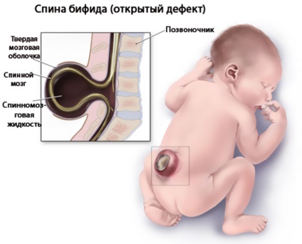 Splitarea congenitală a coloanei vertebrale și a herniei la nou-născut - care sunt șansele unui copil de a avea o sănătate