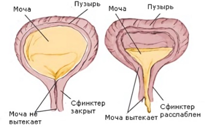 Adenomul prostatei la bărbați cu simptome și tratament cu medicamente populare