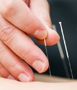 Acupunctura necesită respectarea cerințelor de control al infecțiilor