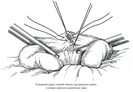 Allsurgery - deteriorarea intestinului subțire 1