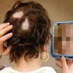 Alopecia cauzează și tratamentul