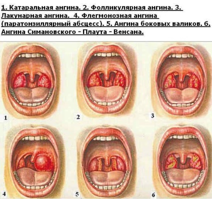 Angina terhesség alatt a tünetek és kezelés első trimeszterében