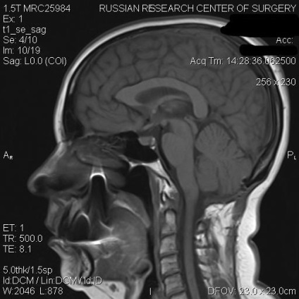 O anomalie arnold-chiari