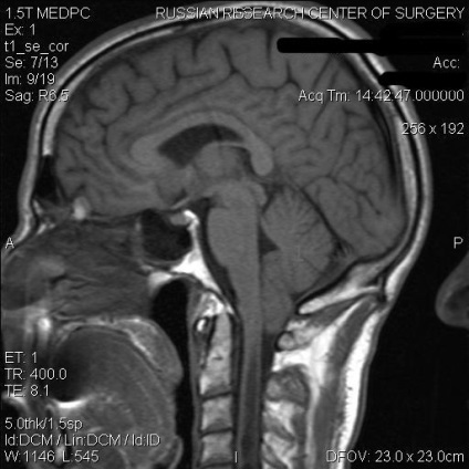 Arnold-chiari anomália