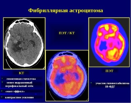 Brain астроцитом - какво е това