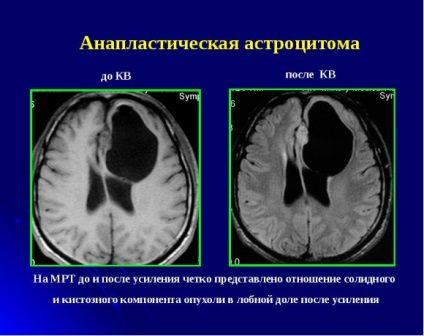 Astrocytoma az agy - mi az?