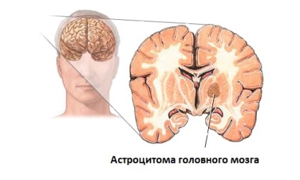 Мозъчна астроцитом видове (анапластичен, фибриларен т.н.), прогнози, симптоми, лечение