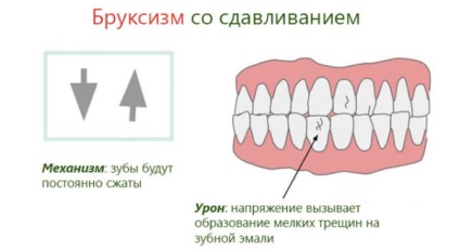 Bruxismul la copii tratamentul rapid al măcinării dinților în somn