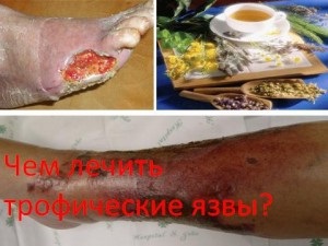 Mint a trofikus fekélyek kezelése (kezelés) Mint a trofikus fekélyek kezelése
