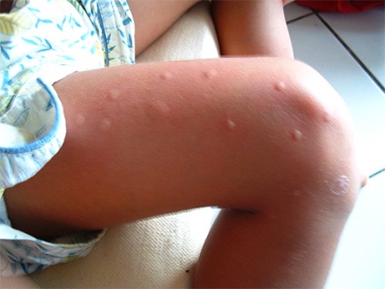 Cum să faceți o mușcătură de țânțari cu cele mai bune creme și unguente - primul ajutor pentru mușcăturile de țânțari - articole
