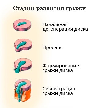 Than herniation de o coloana vertebrală a unui departament lombar este periculos 6 amenințări