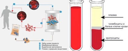Cum se înlocuiește plasmafereza