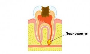 Какво става, ако болния зъб за корона или венците причини