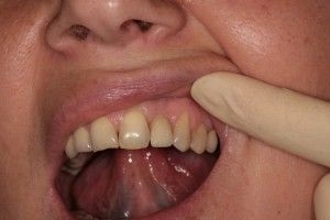 Ce se poate face dacă dintele este rănit sub coroană sau cauzează gingia
