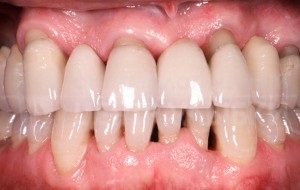Ce trebuie să faceți dacă gingia se îndepărtează de dinte