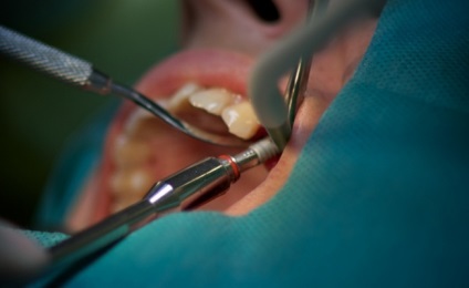 Ce se poate face dacă dintele a căzut, vitaportal - sănătate și medicină