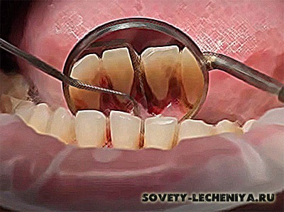 Ce se poate face dacă gingia sângerează, durerile dinți și afectează cariile