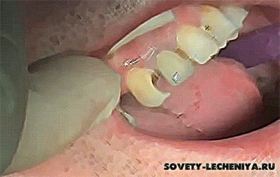Ce se poate face dacă gingia sângerează, durerile dinți și afectează cariile