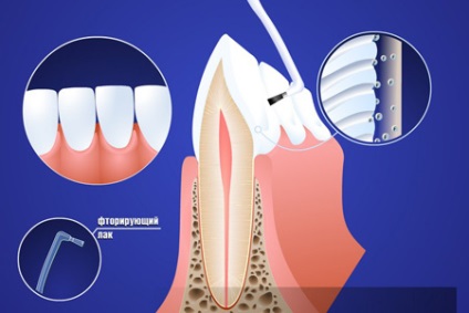 Ce este fluorizarea dinților cu fluorizarea dinților sugarilor la copii