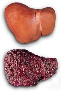 Цироза на черния дроб - традиционната медицина - рецепти на традиционната медицина и алтернативни терапии