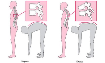 Deformarea secțiunilor coloanei vertebrale (scoliotice, kyfotice), tratament