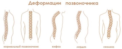 Deformarea coloanei vertebrale