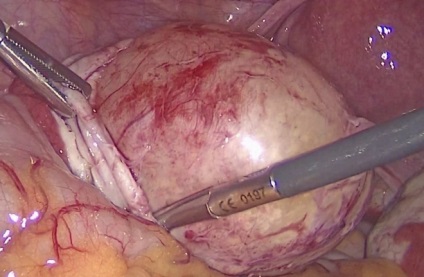 Dermaid ovarian cyst fotografie, video, descriere