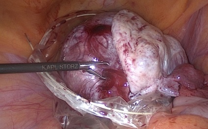 Dermaid ovarian cyst fotografie, video, descriere