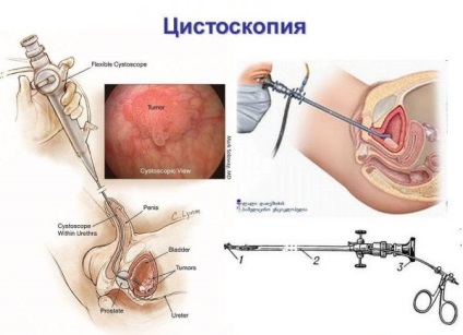 Diagnosticul în urologie al uretrocistoscopiei