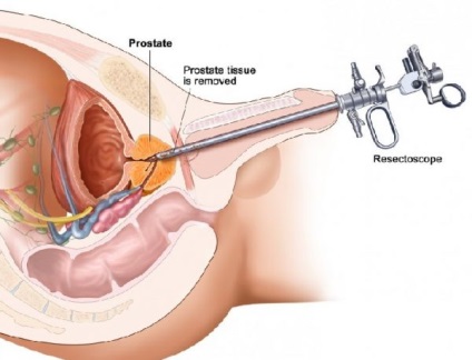 Diagnosticul în urologie al uretrocistoscopiei