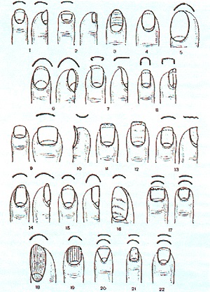 Diagnosticarea bolilor prin cuie